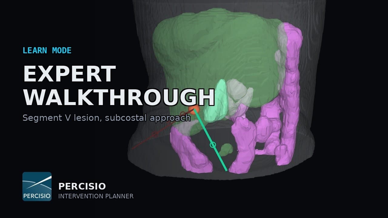 Expert Walkthrough: Segment V Lesion, Subcostal Approach