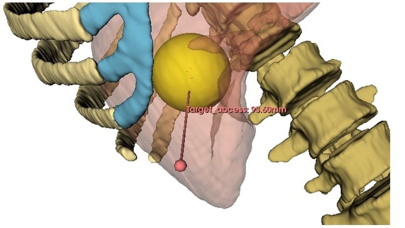 Percisio hologram abscess view 1