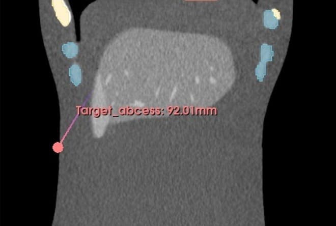 Percisio hologram abscess view 2