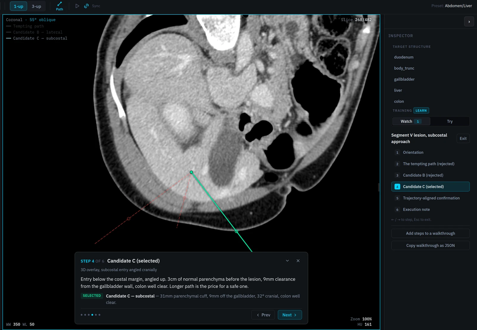 Learn mode in Percisio Intervention Planner: the selected subcostal path drawn solid on an obliquely recut CT, the rejected candidates dashed, with the operator's narration beside them.